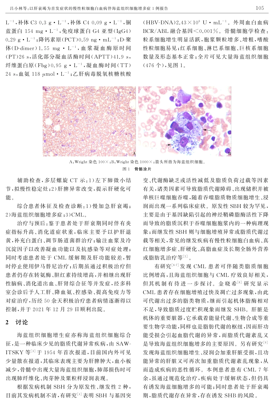 以肝衰竭为首发症状的慢性粒细胞白血病伴海蓝组织细胞增多症1例报告.pdf_第2页