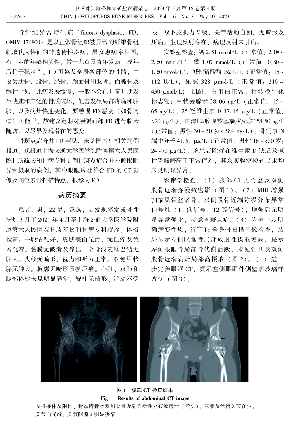 骨斑点症合并眼眶骨异常一例报告.pdf_第2页