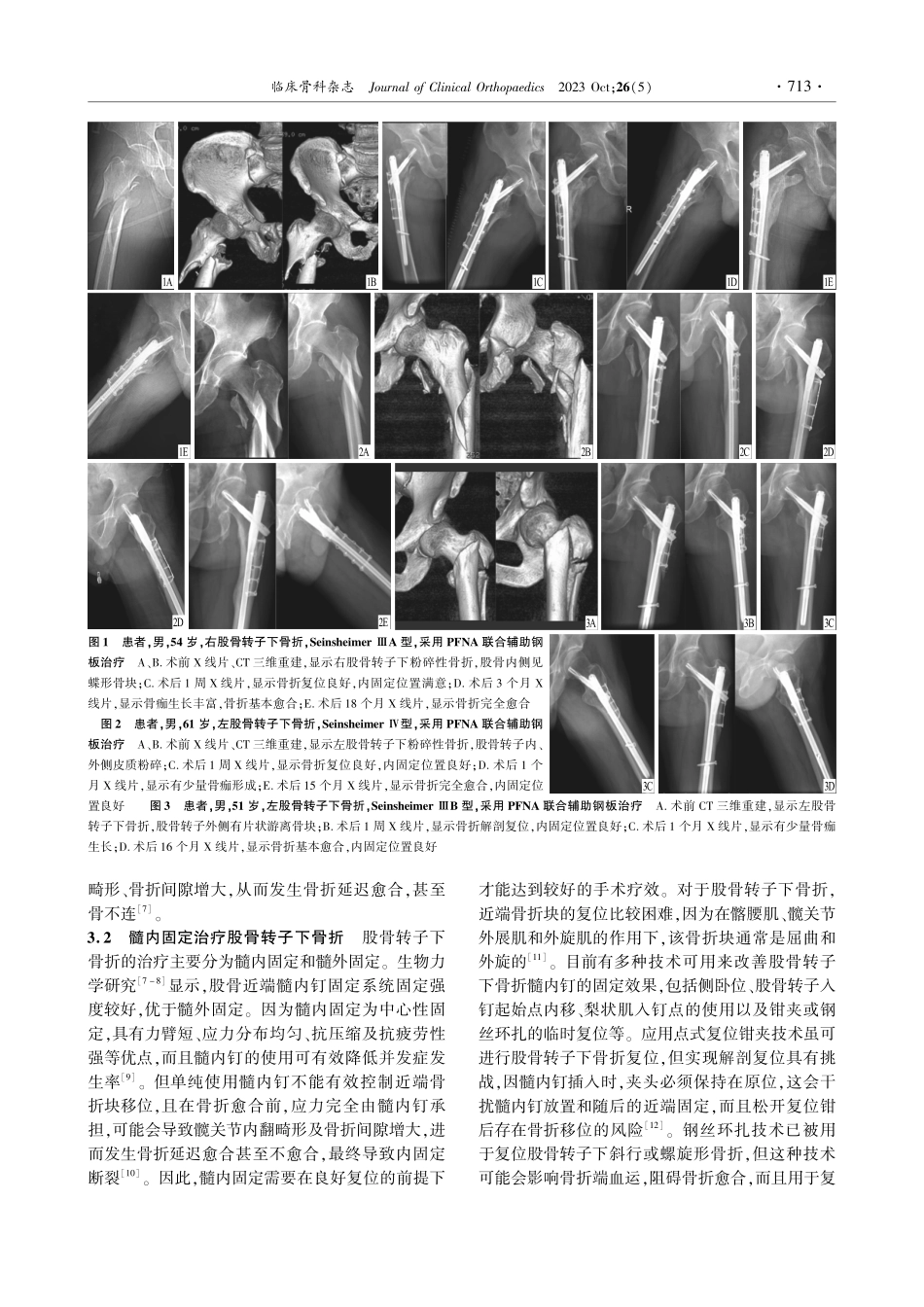 股骨近端防旋髓内钉联合辅助钢板治疗股骨转子下骨折.pdf_第3页
