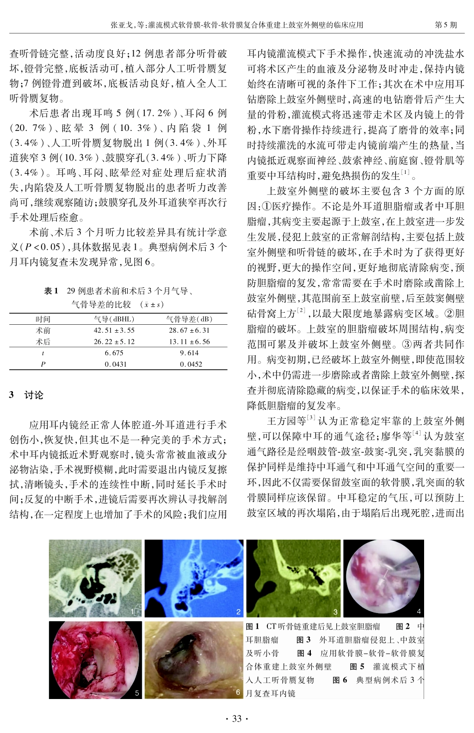灌流模式软骨膜-软骨-软骨膜复合体重建上鼓室外侧壁的临床应用.pdf_第3页