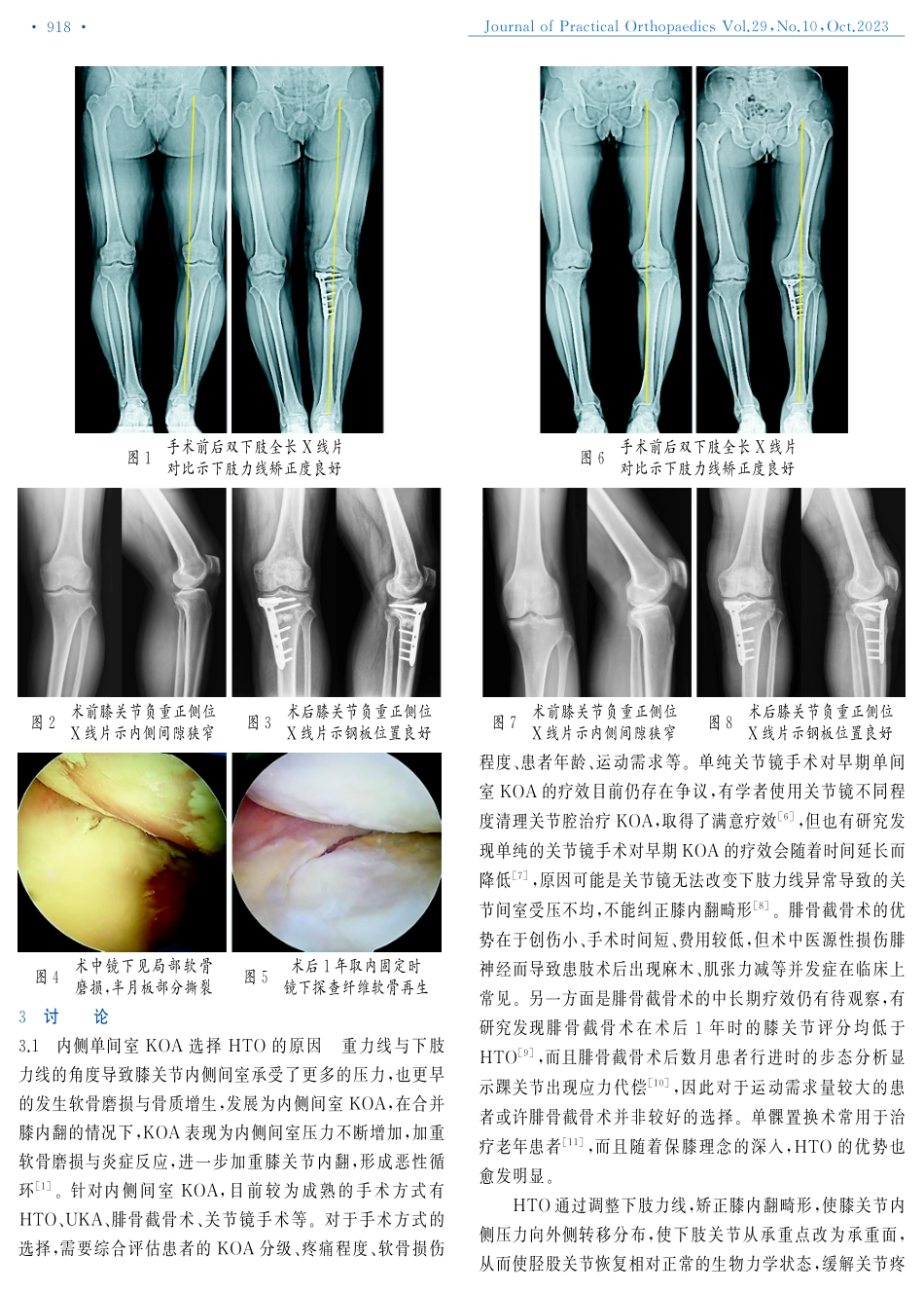 关节镜辅助胫骨内侧开放楔形截骨术治疗内侧间室膝骨关节炎.pdf_第3页