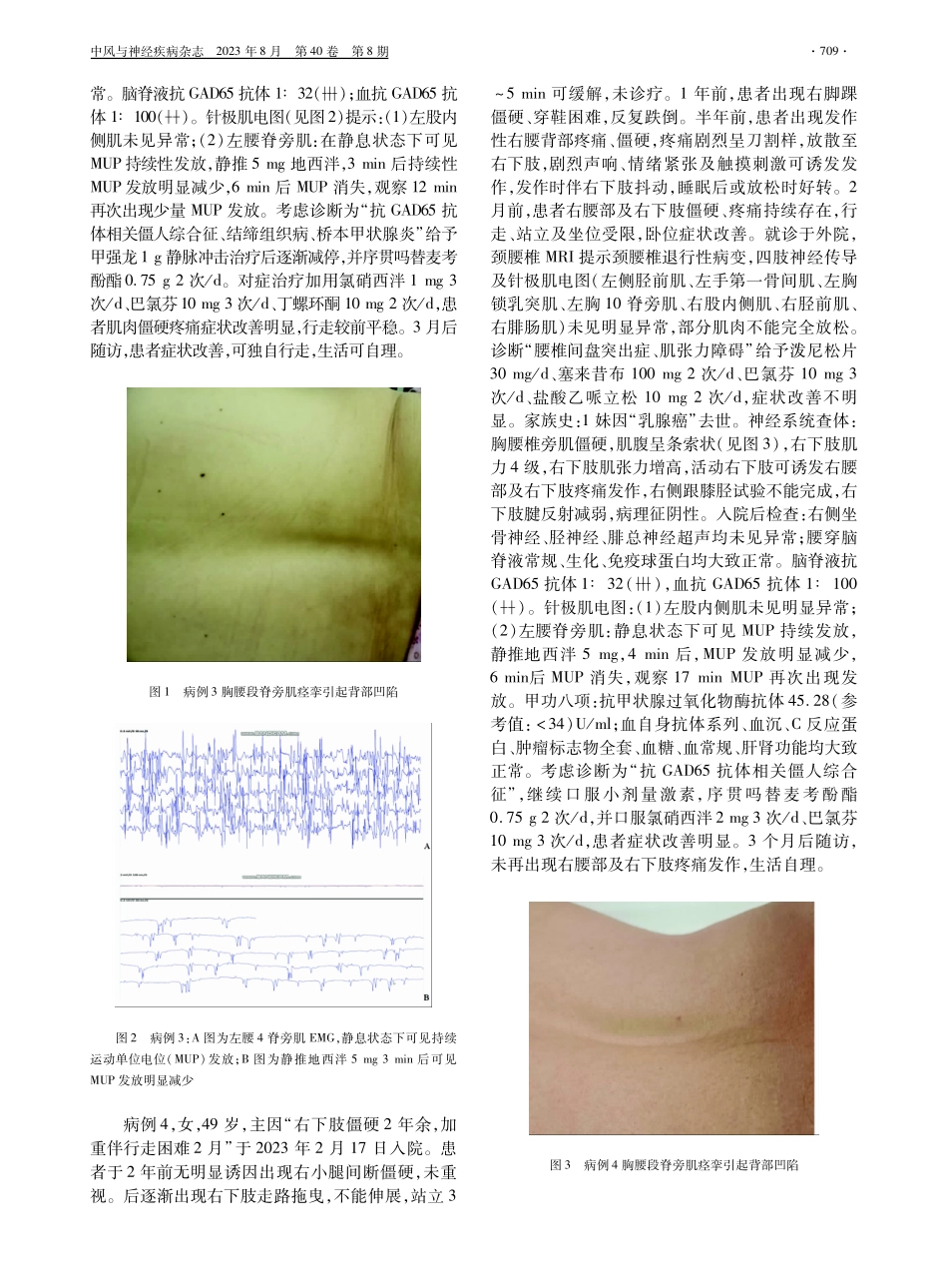 抗GAD65抗体相关僵人综合征4例临床分析.pdf_第3页