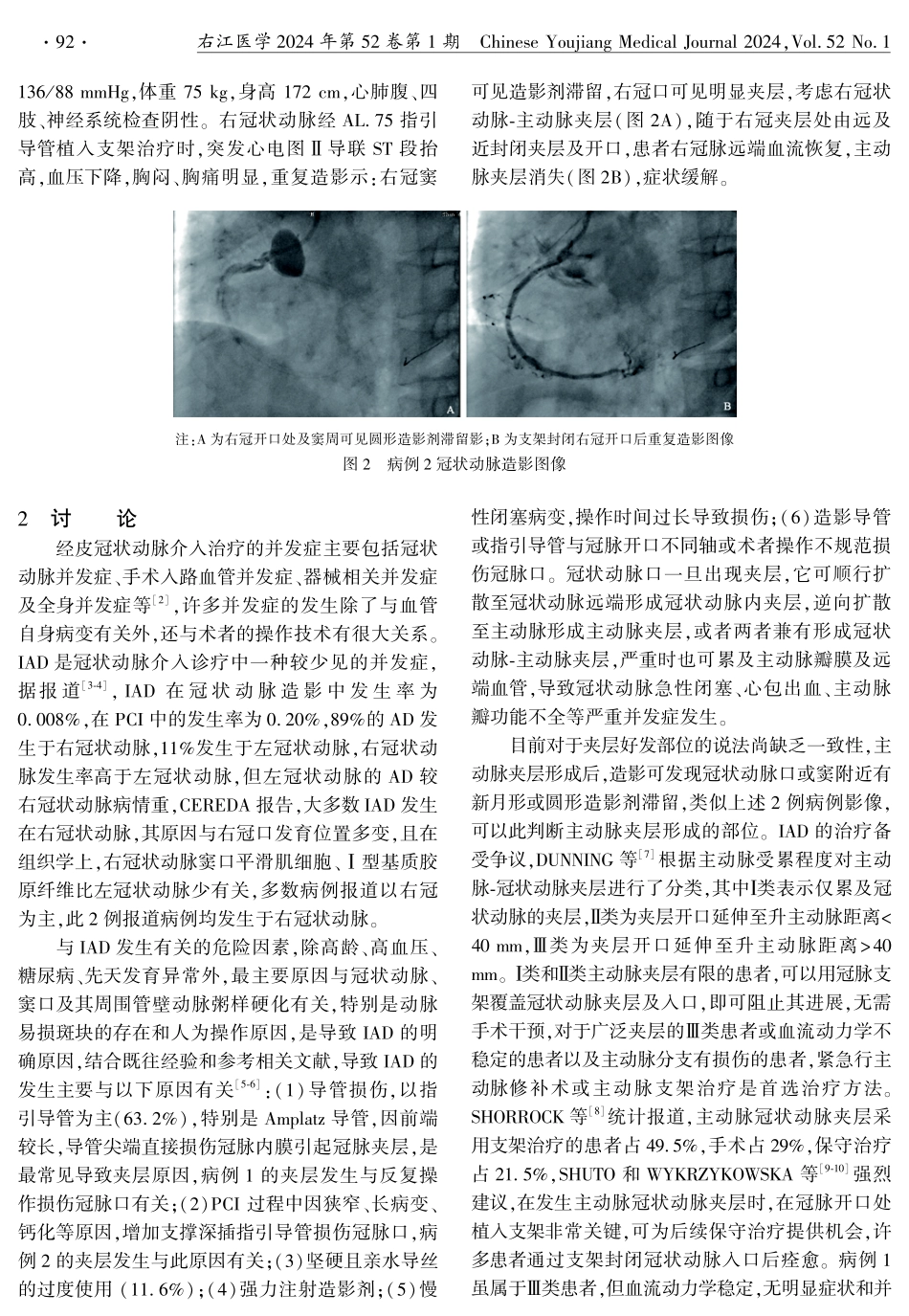 冠状动脉介入诊疗致医源性主动脉夹层2例分析.pdf_第2页