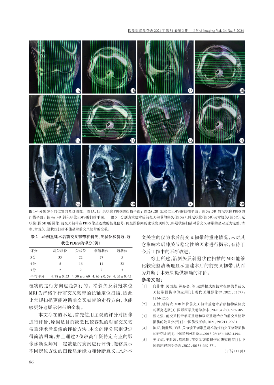前交叉韧带重建术后的磁共振扫描技术分析.pdf_第3页