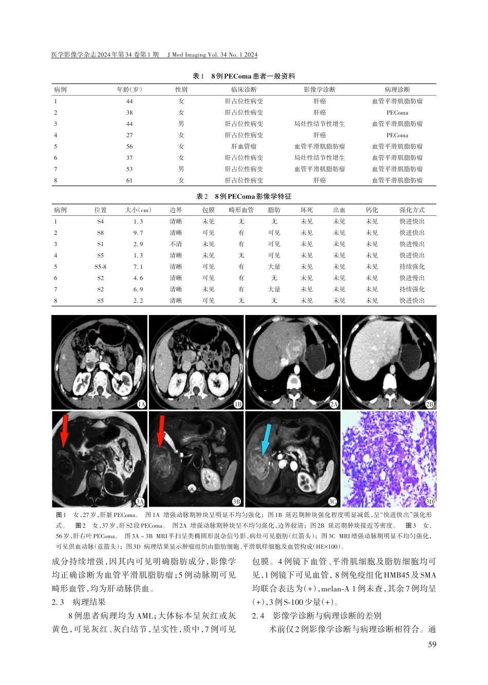 肝脏血管周上皮样细胞瘤的CT、MRI表现和病理对照分析.pdf_第3页