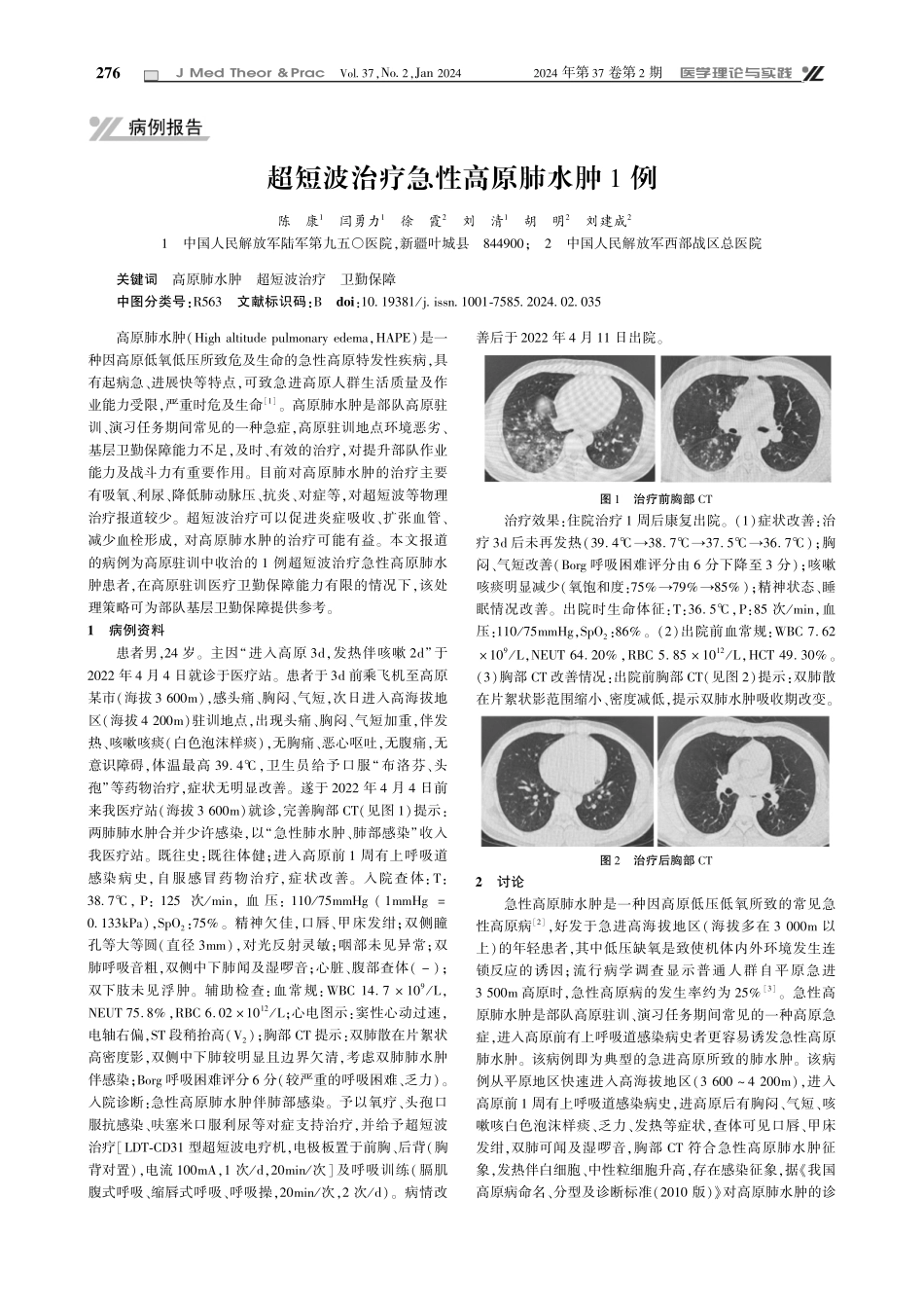 超短波治疗急性高原肺水肿1例.pdf_第1页