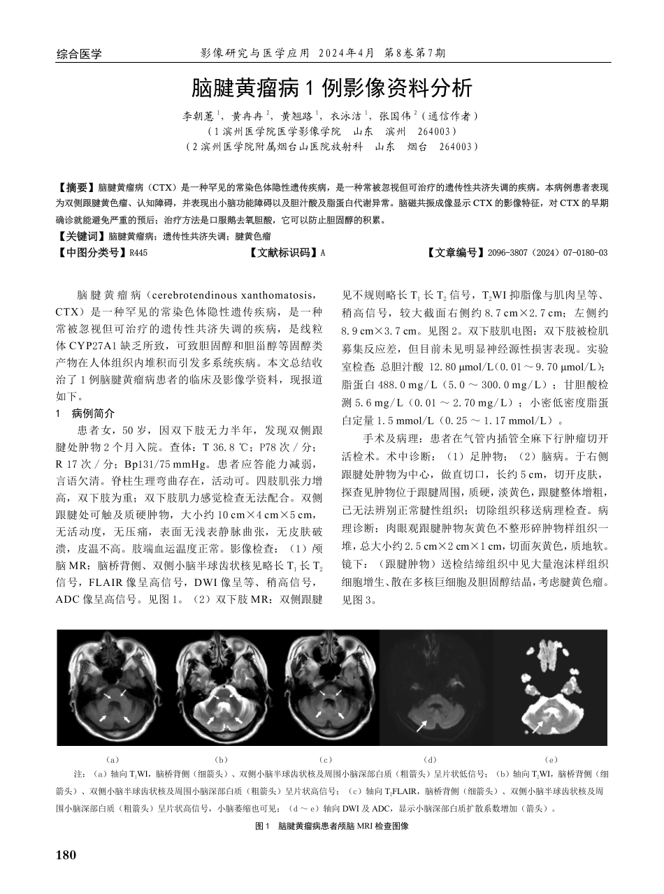 脑腱黄瘤病1例影像资料分析.pdf_第1页