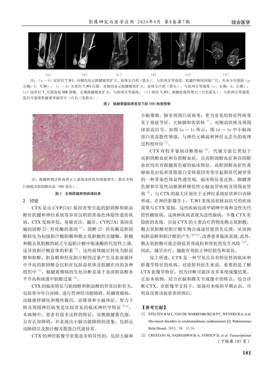 脑腱黄瘤病1例影像资料分析.pdf_第2页