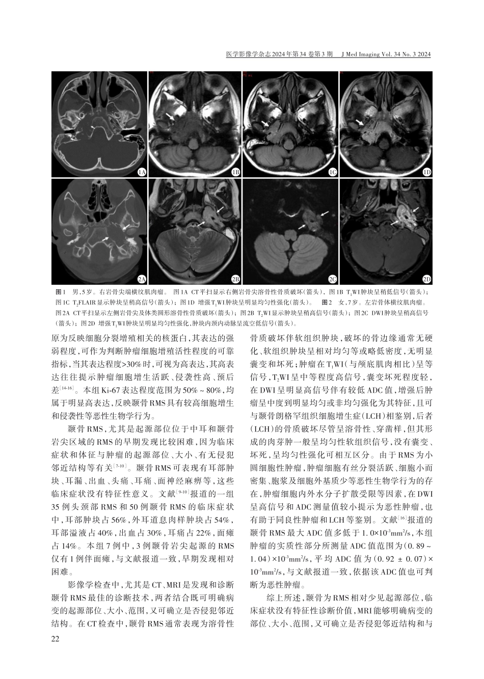 儿童颞骨横纹肌肉瘤的CT和MRI表现.pdf_第3页