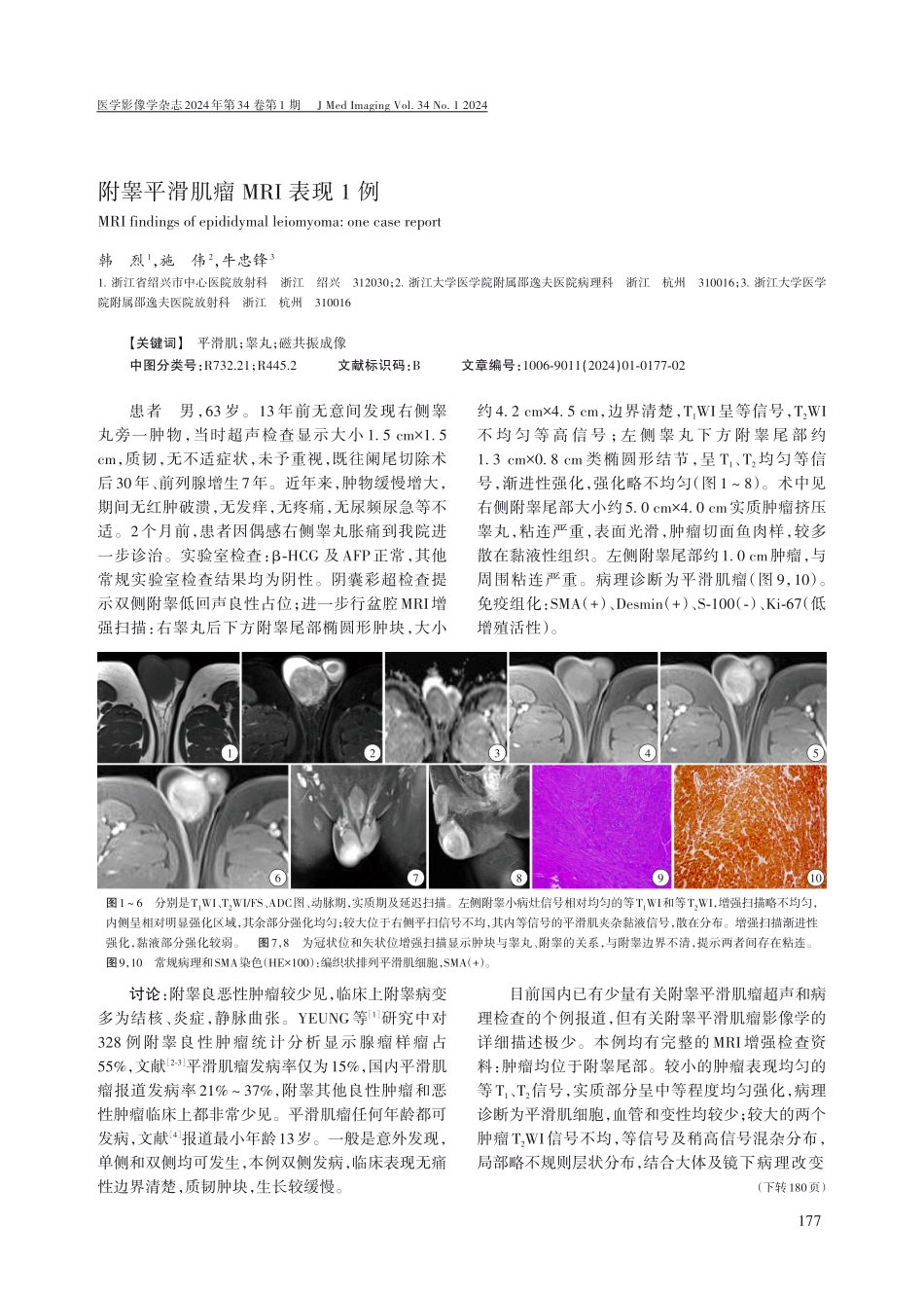 附睾平滑肌瘤MRI表现1例.pdf_第1页