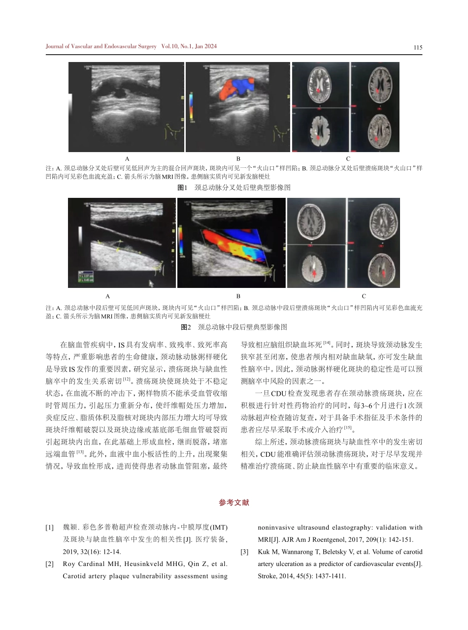 颈动脉溃疡斑块与缺血性脑卒中发生的关系.pdf_第3页