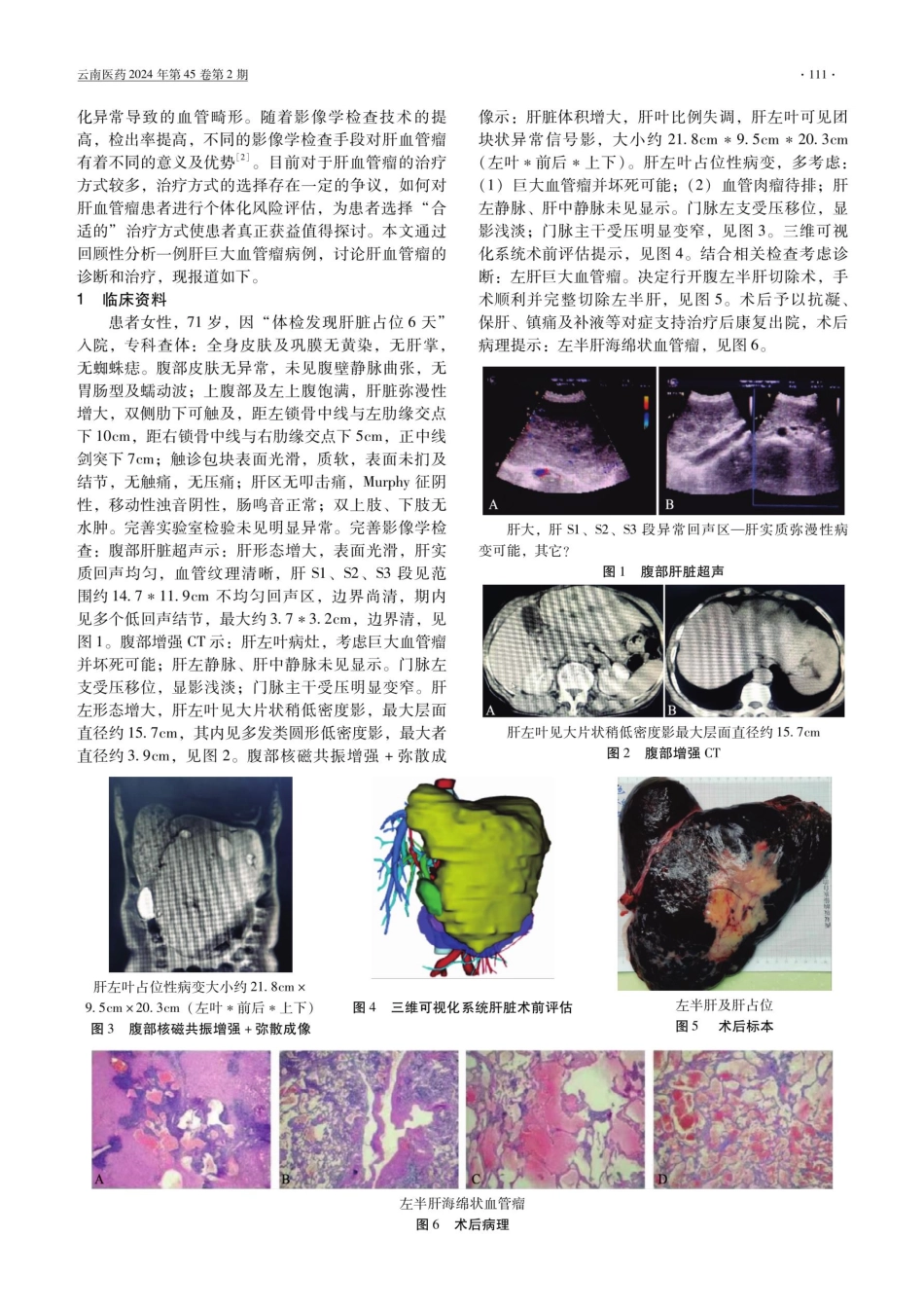 肝巨大血管瘤诊疗1例并文献回顾.pdf_第2页