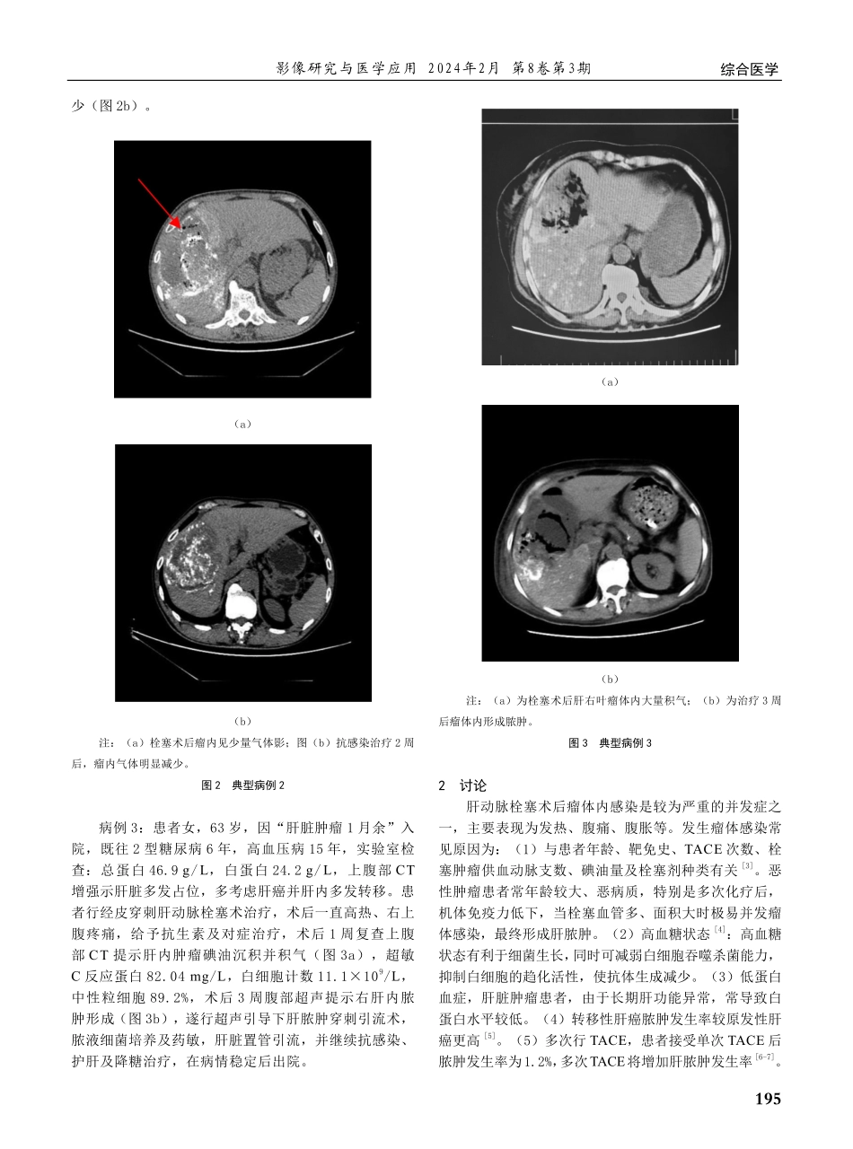 肝脏肿瘤栓塞术后瘤体感染形成原因分析及处理%28附3例报告%29.pdf_第2页