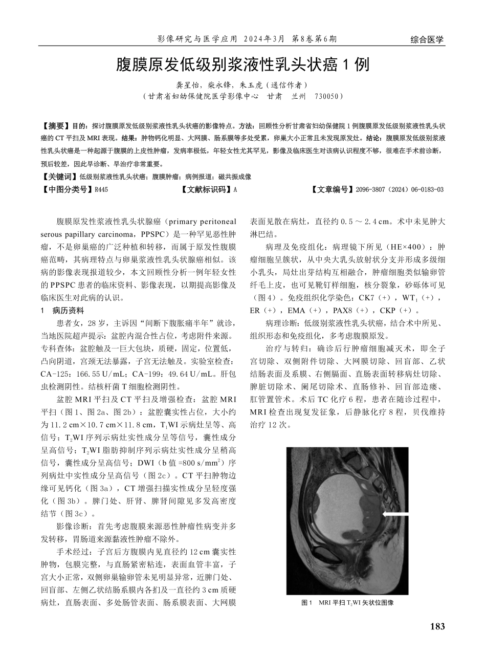 腹膜原发低级别浆液性乳头状癌1例.pdf_第1页