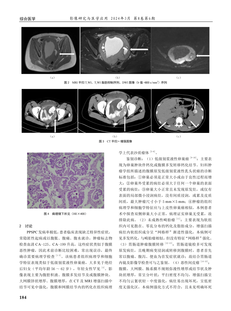 腹膜原发低级别浆液性乳头状癌1例.pdf_第2页