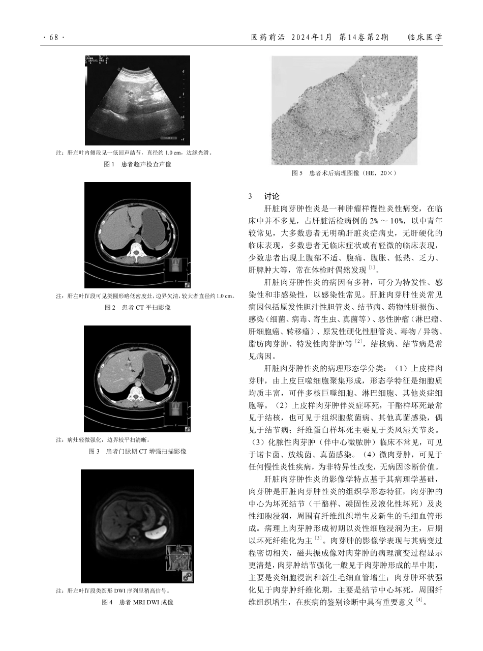 肝脏肉芽肿性炎影像学表现分析.pdf_第2页