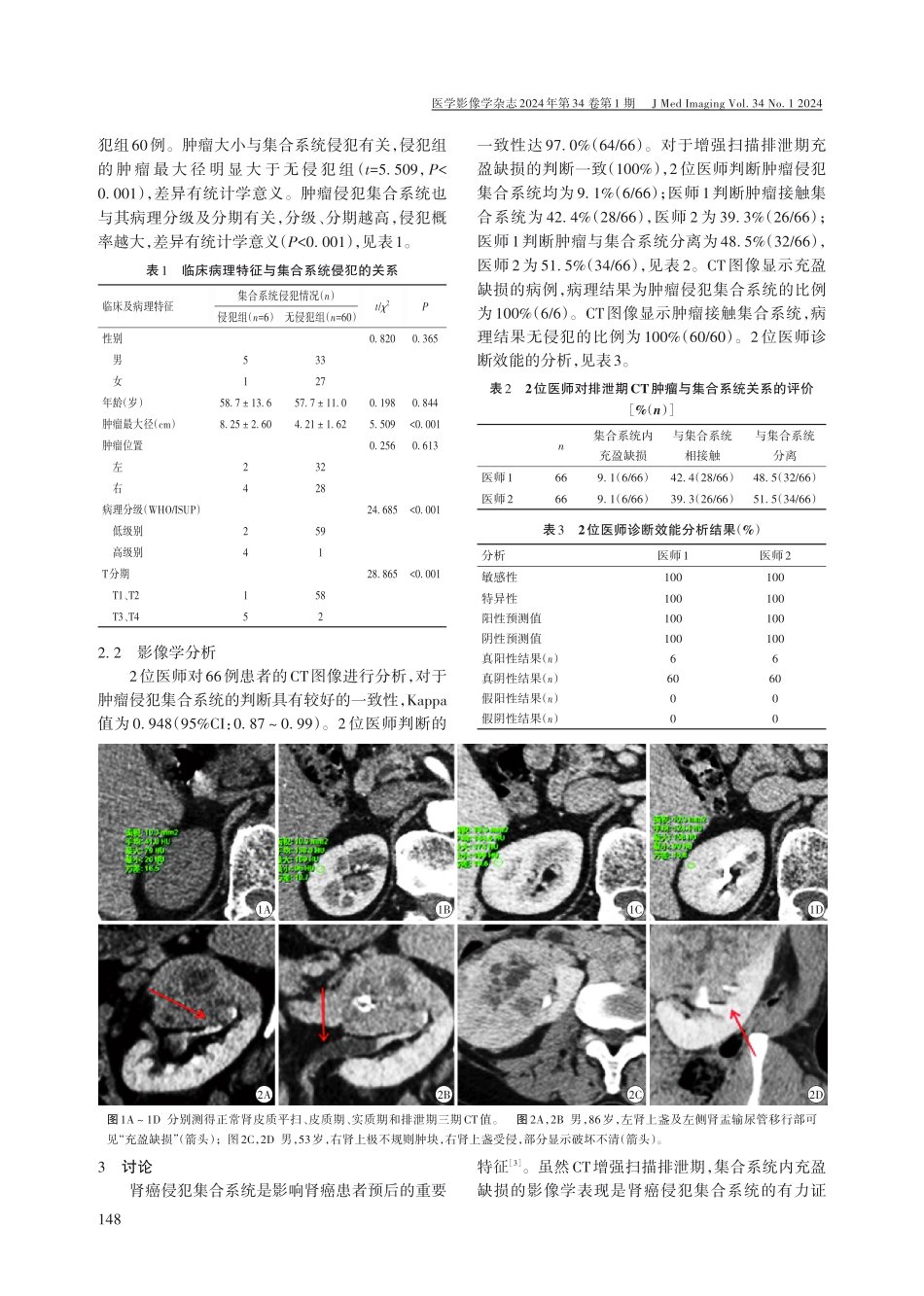 多层螺旋CT对肾癌侵犯集合系统的评价.pdf_第2页