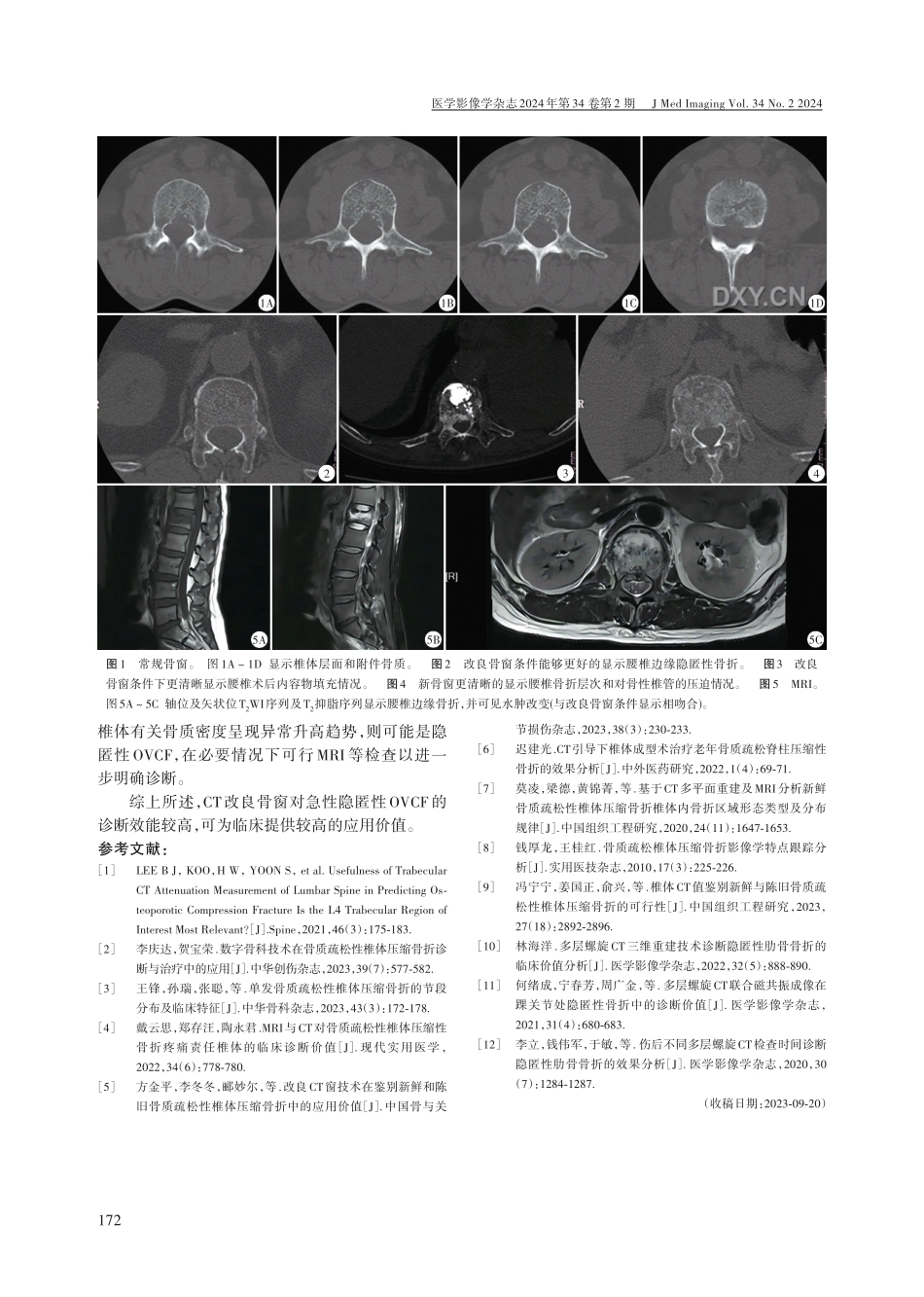 改良CT窗技术在急性隐匿性骨质疏松性椎体压缩骨折诊断中的应用.pdf_第3页