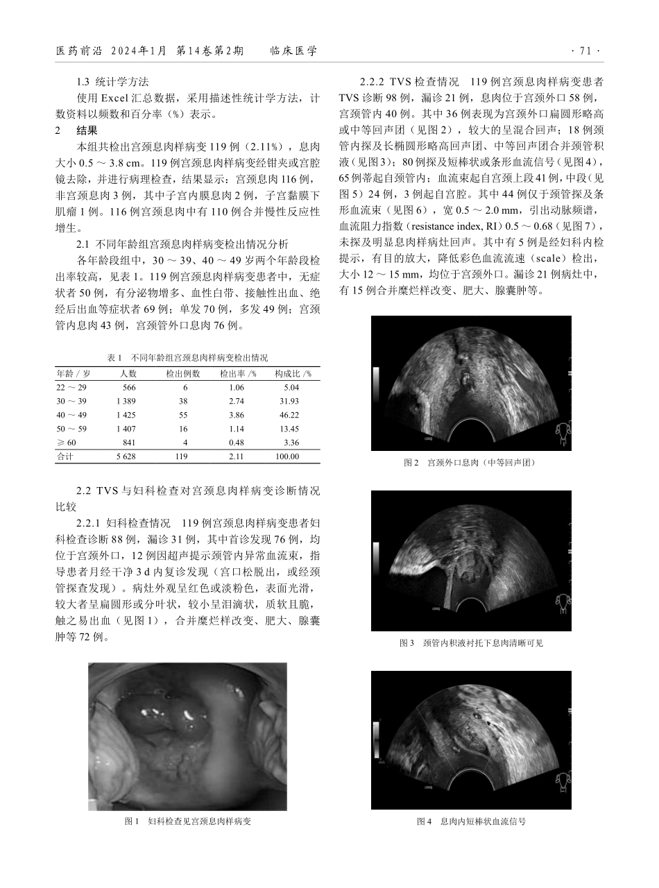经阴道超声联合妇科检查在宫颈息肉样病变中的诊断价值分析.pdf_第2页