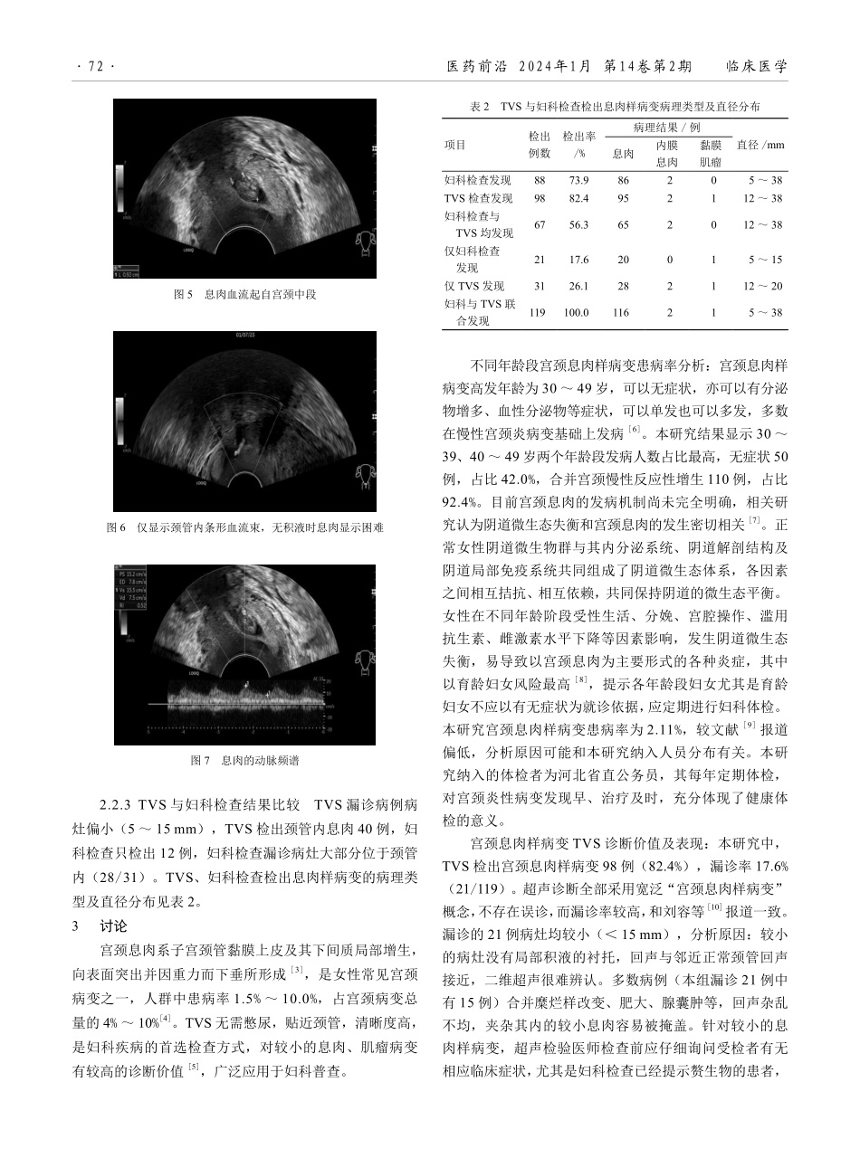 经阴道超声联合妇科检查在宫颈息肉样病变中的诊断价值分析.pdf_第3页