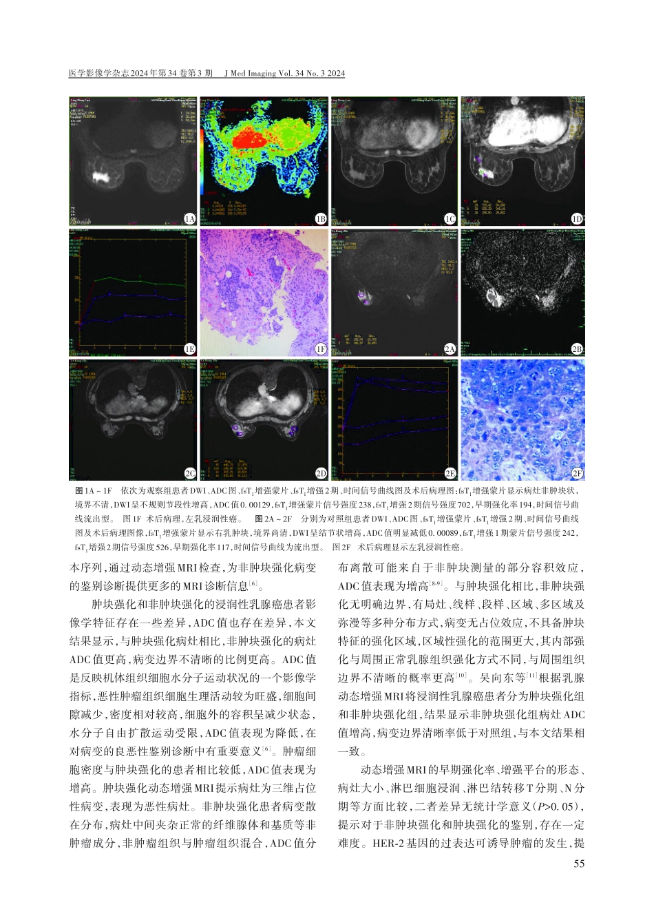 浸润性乳腺癌患者非肿块强化和肿块强化的动态增强MRI特征分析.pdf_第3页