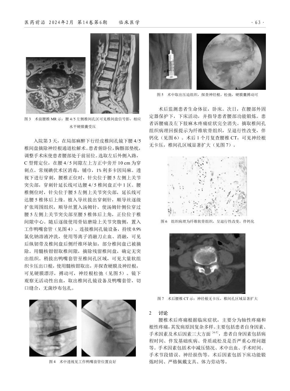 经皮椎间孔镜治疗腰椎全椎板减压术后根性疼痛1例报告.pdf_第2页