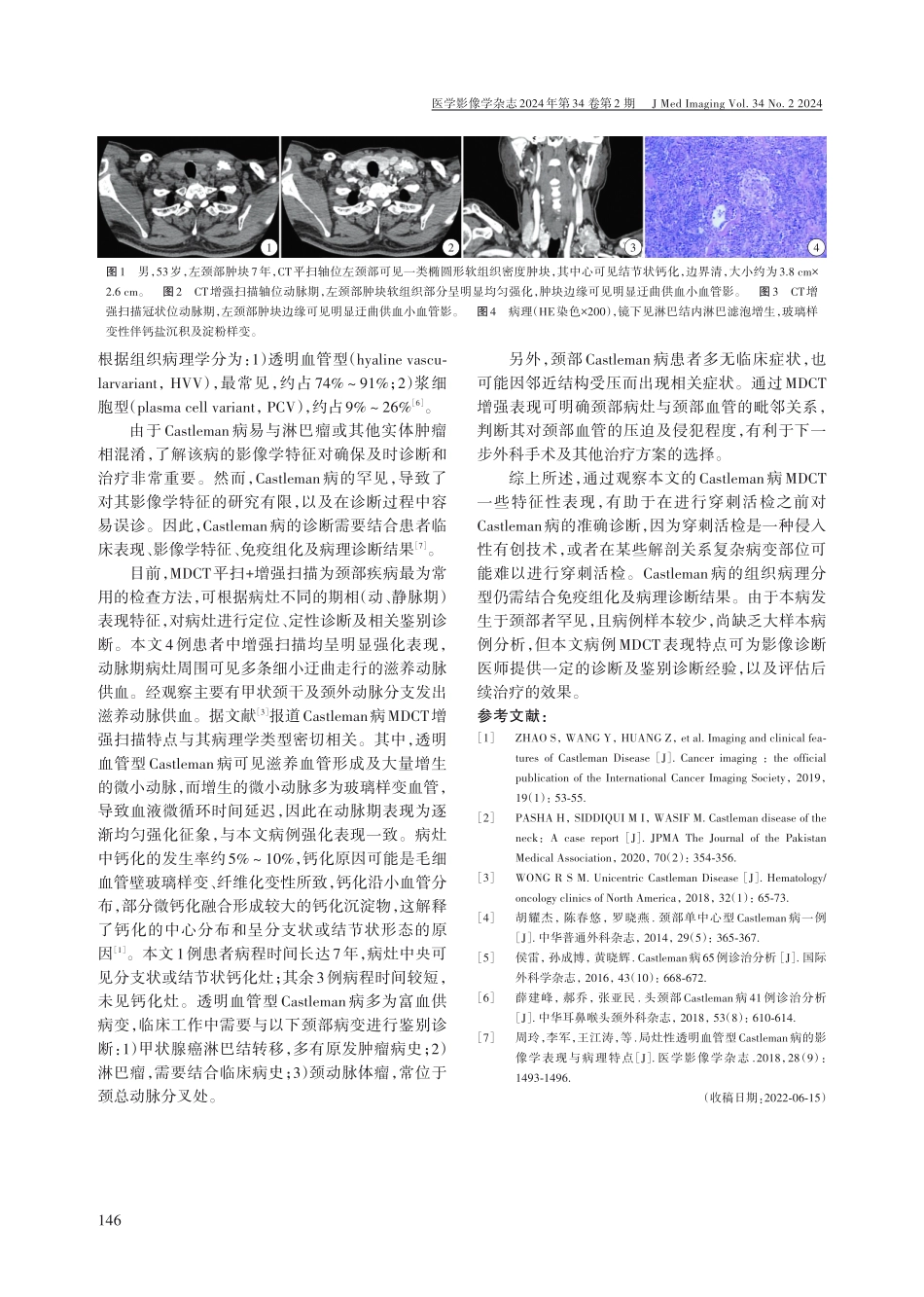 颈部透明血管型Castleman病MDCT表现与病理对照.pdf_第2页