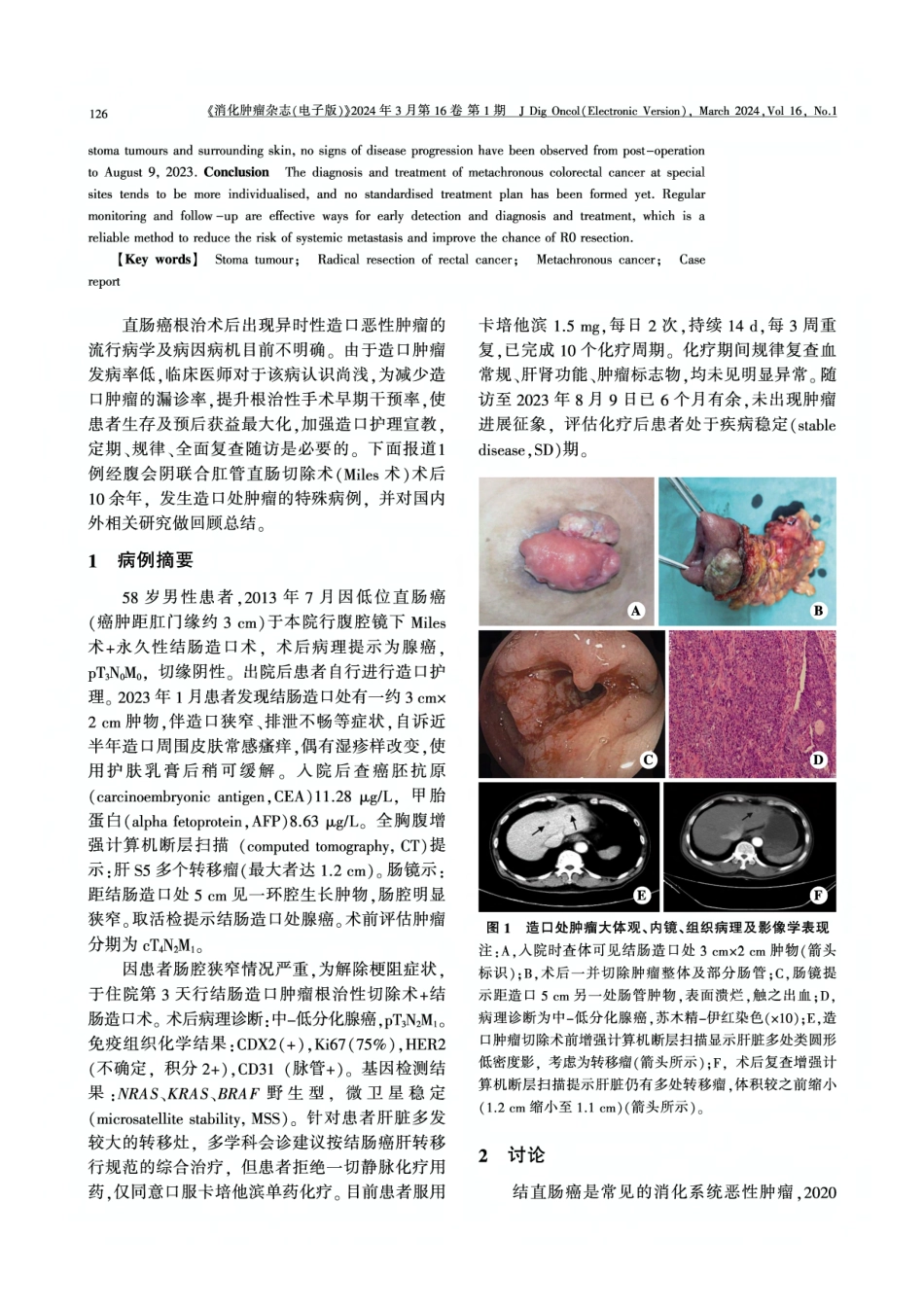 经腹会阴联合直肠癌根治术后造口肿瘤并同时性肝转移1例报道及文献复习.pdf_第2页