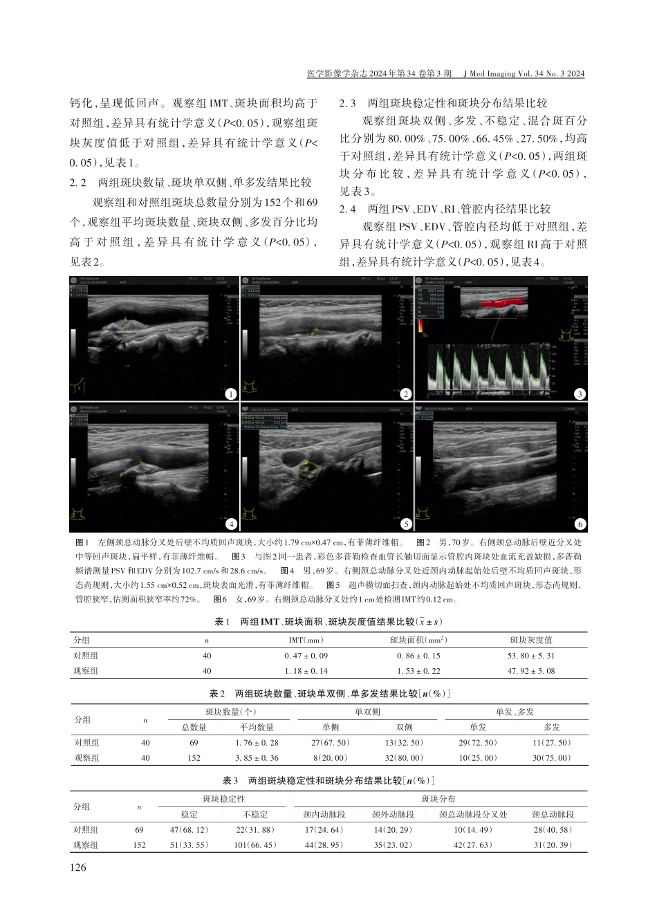颈动脉斑块超声筛查在预防脑卒中的临床价值.pdf_第2页