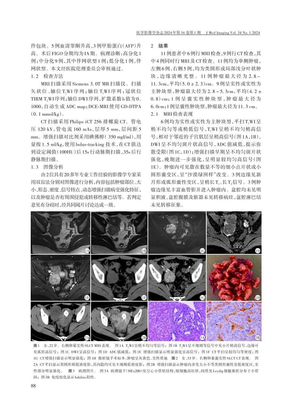 卵巢支持-间质细胞肿瘤的临床及影像学特征.pdf_第2页