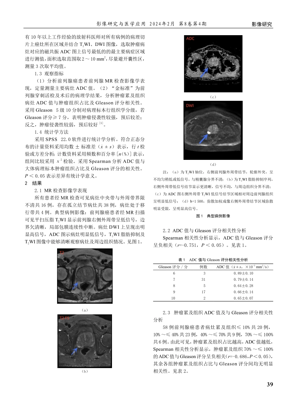 前列腺癌磁共振弥散加权成像病灶ADC值与根治术标本肿瘤组织占比及Gleason评分的相关性分析.pdf_第2页