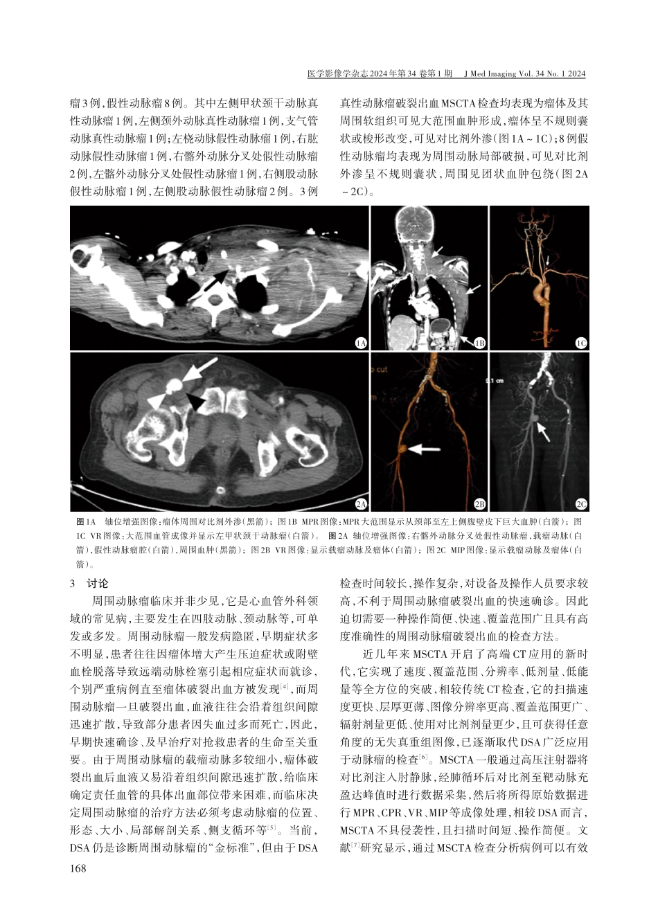 多层螺旋CT血管成像在周围动脉瘤破裂出血诊断中的临床应用.pdf_第2页