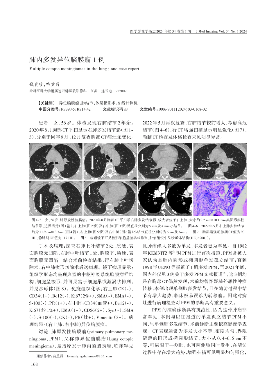 肺内多发异位脑膜瘤1例.pdf_第1页