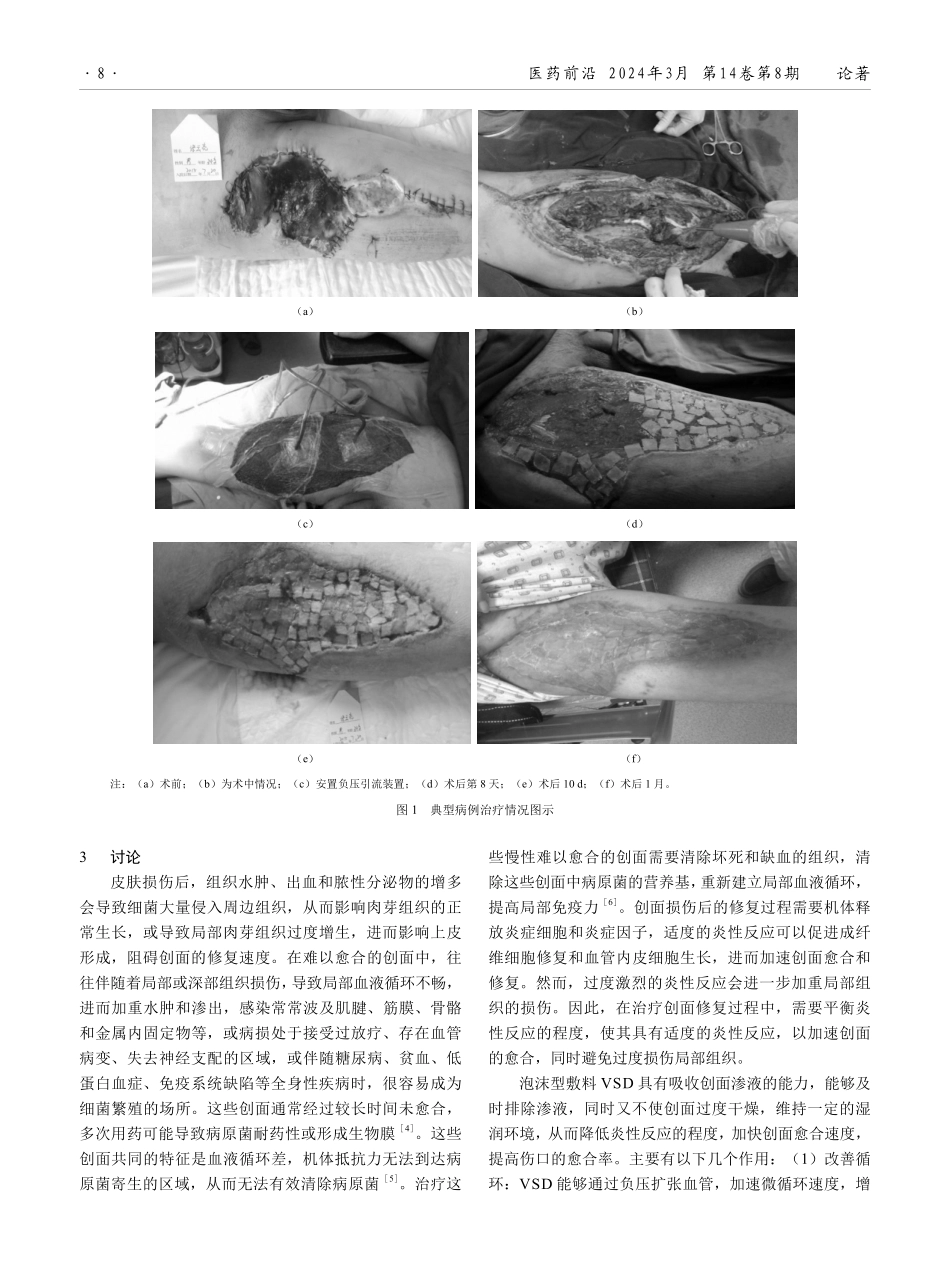 负压封闭引流联合威伐光治疗难愈性创面的临床效果观察.pdf_第3页