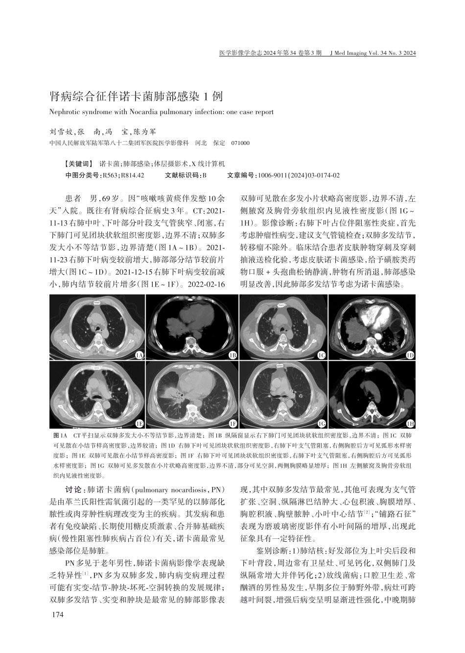 肾病综合征伴诺卡菌肺部感染1例.pdf_第1页