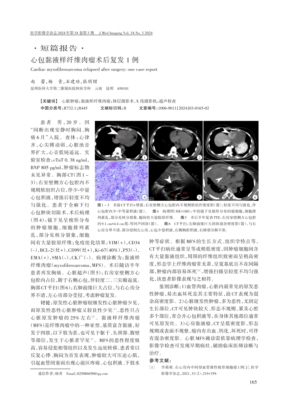 心包黏液样纤维肉瘤术后复发1例.pdf_第1页