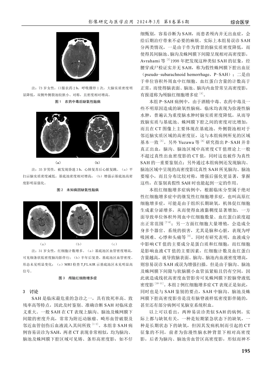易误诊为蛛网膜下腔出血的CT征象分析.pdf_第2页
