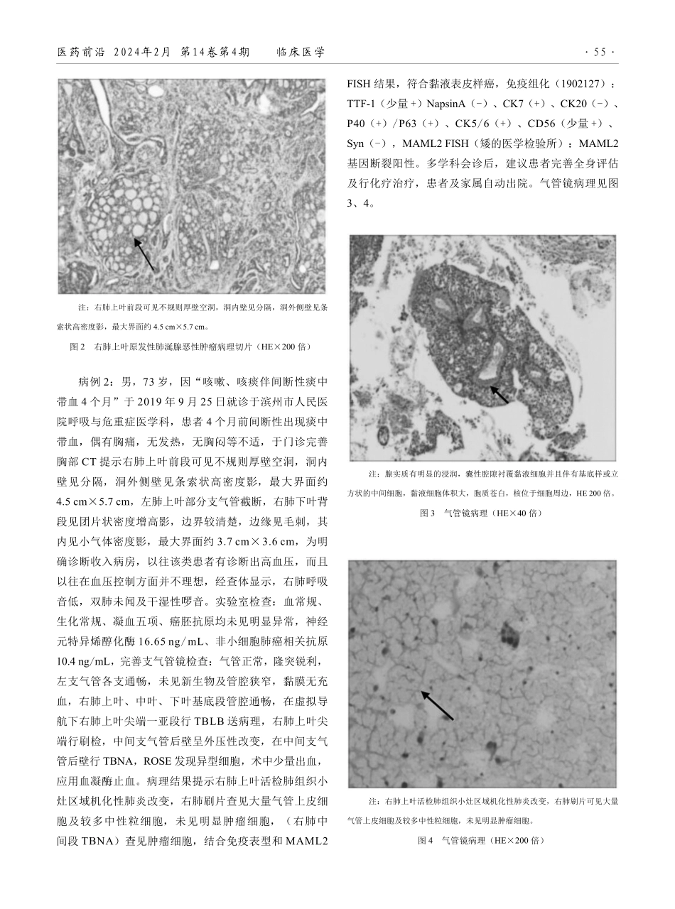 原发性肺涎腺恶性肿瘤2例诊治报道并文献复习.pdf_第2页