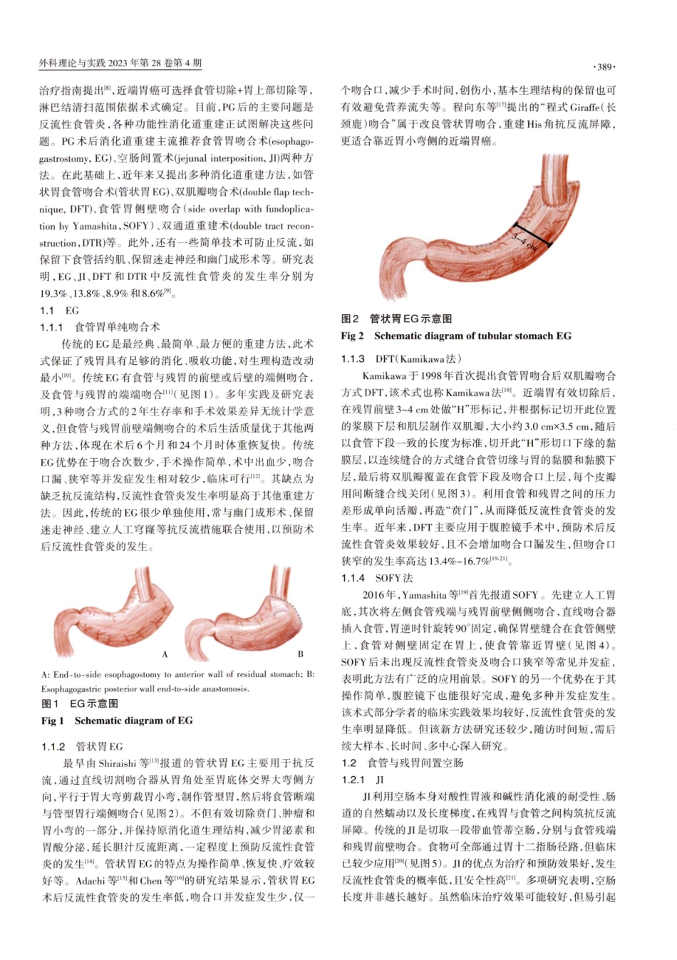 近端胃切除抗反流消化道重建方式的研究进展.pdf_第2页