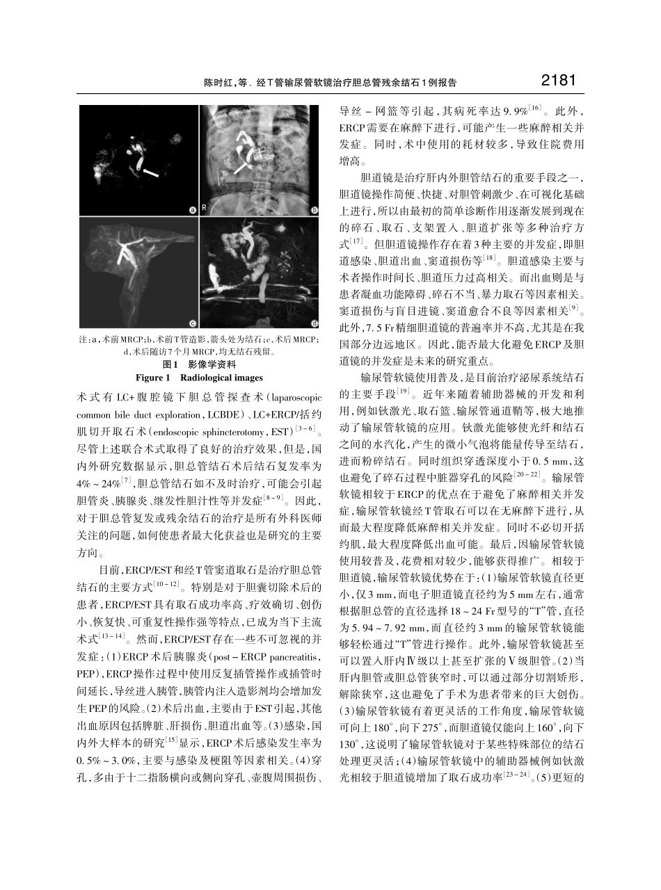 经T管输尿管软镜治疗胆总管残余结石1例报告.pdf_第3页