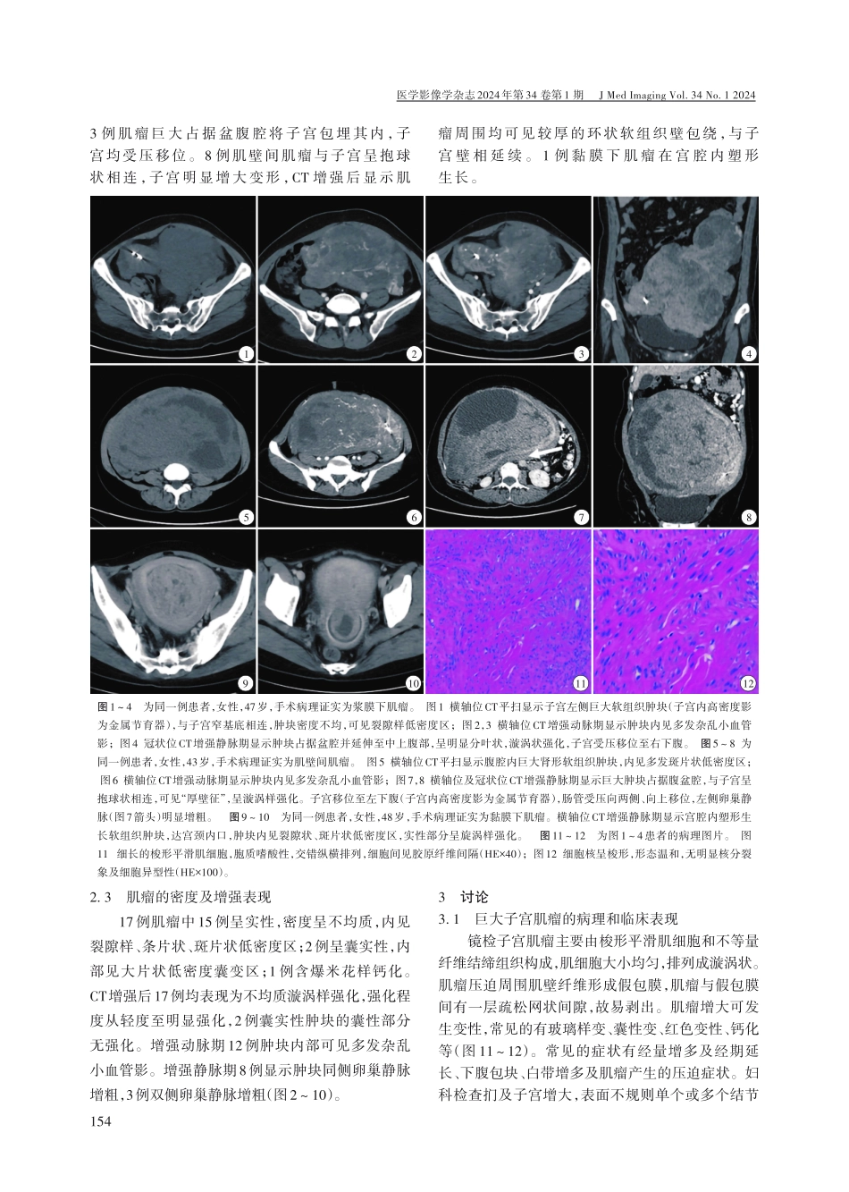 巨大子宫肌瘤的CT特征%28附17例分析%29.pdf_第2页