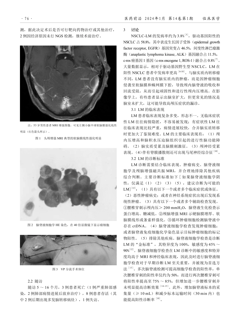 脑室-腹腔分流术治疗高颅压性肺腺癌软脑膜转移12例.pdf_第2页
