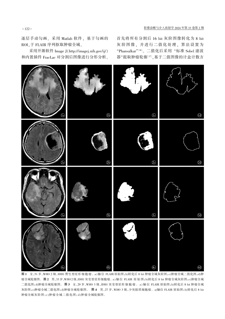 常规MRI分形参数预测成人2-3级弥漫性胶质瘤IDH1突变状态的研究.pdf_第3页