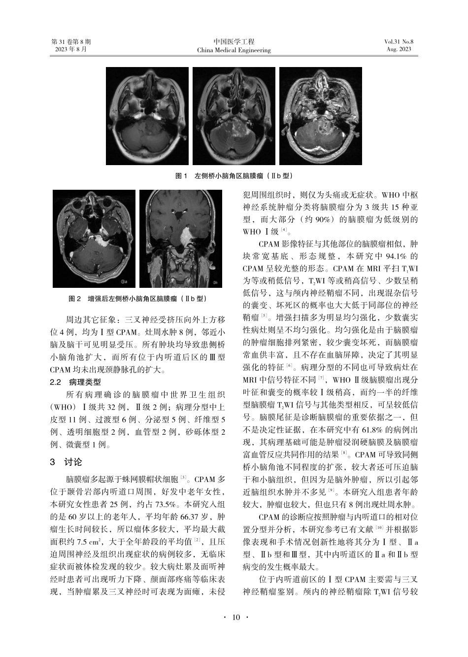 老年患者桥小脑角区脑膜瘤的MRI影像诊断与分析.pdf_第3页