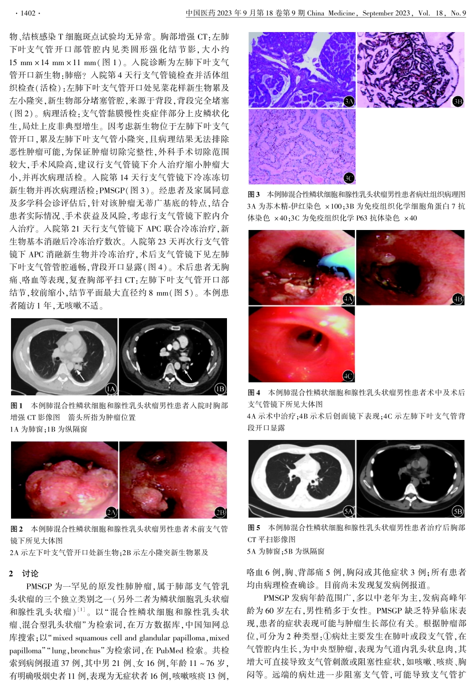 经支气管镜氩等离子凝固术联合冷冻治疗肺混合性鳞状细胞和腺性乳头状瘤1例并文献复习.pdf_第2页