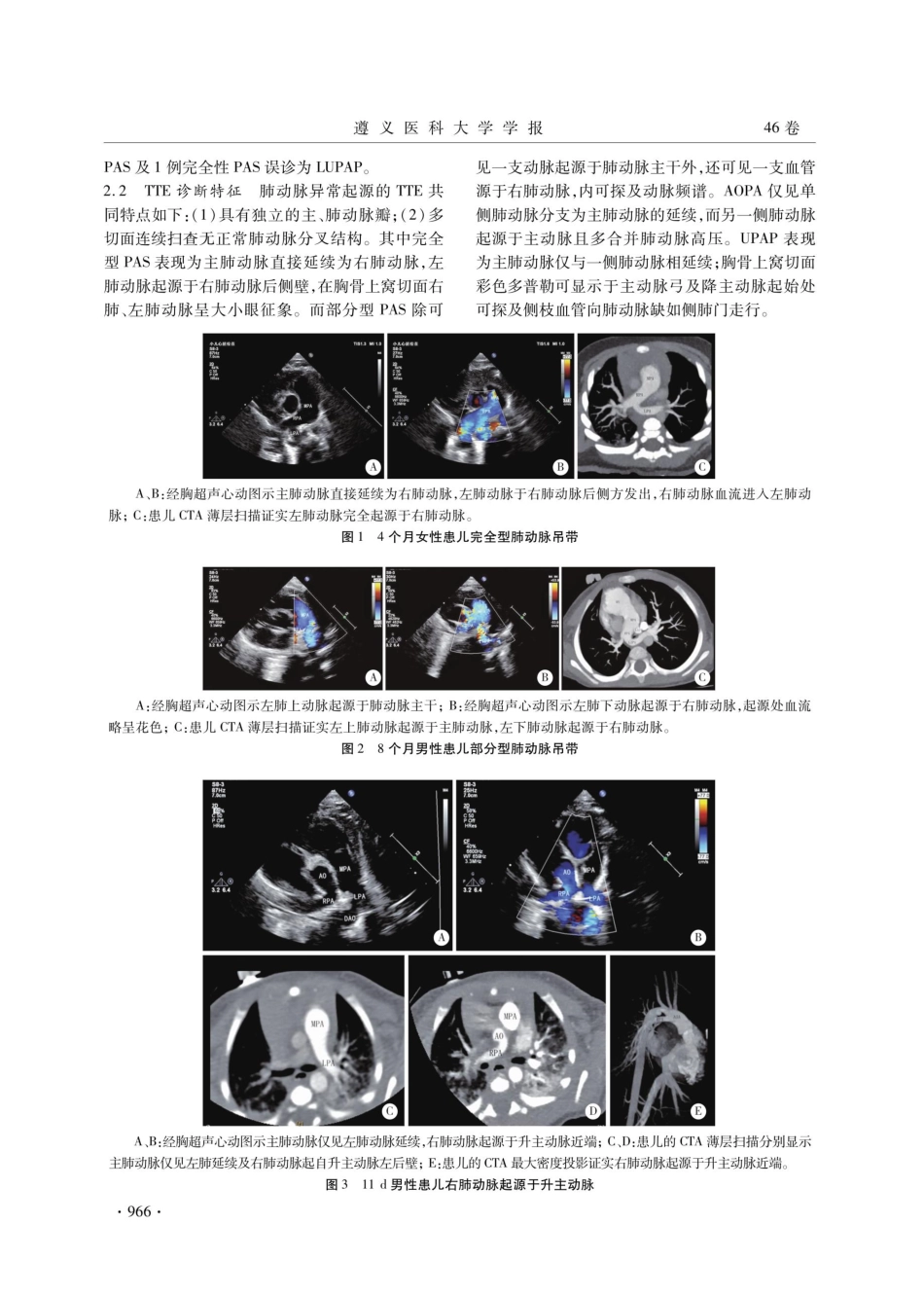 经胸超声心动图诊断儿童肺动脉异常起源的价值.pdf_第3页