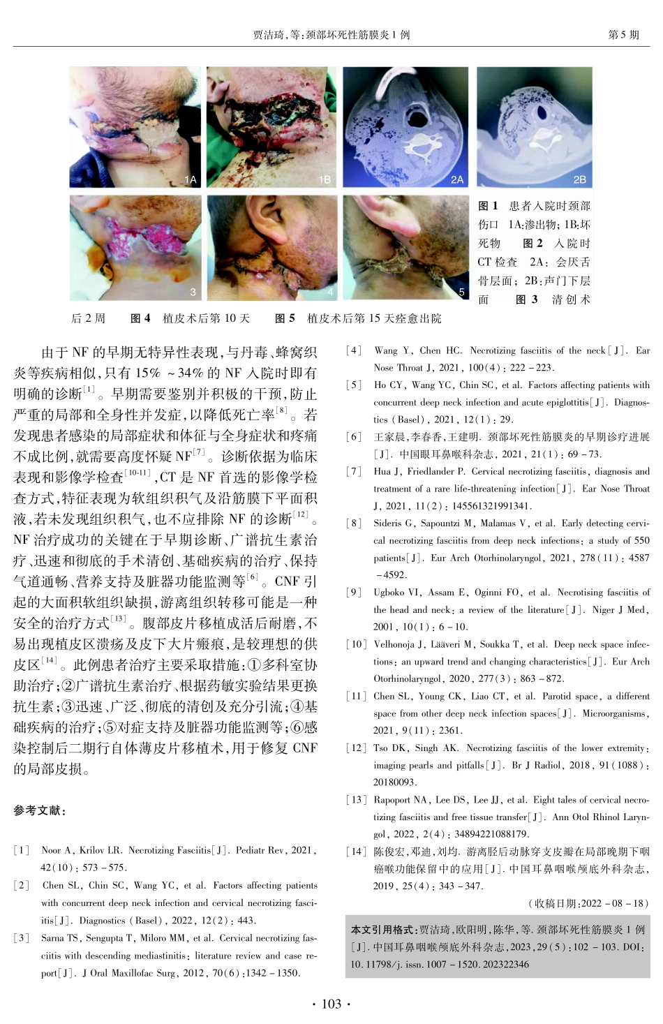 颈部坏死性筋膜炎1例.pdf_第2页