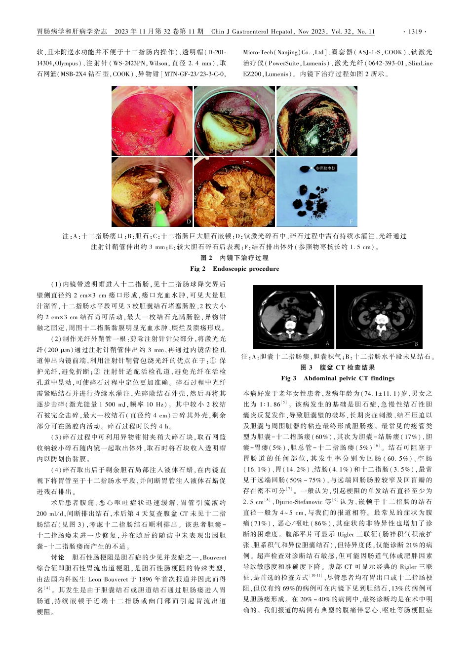 镜下应用钬激光治疗Bouveret综合征1例报道.pdf_第2页