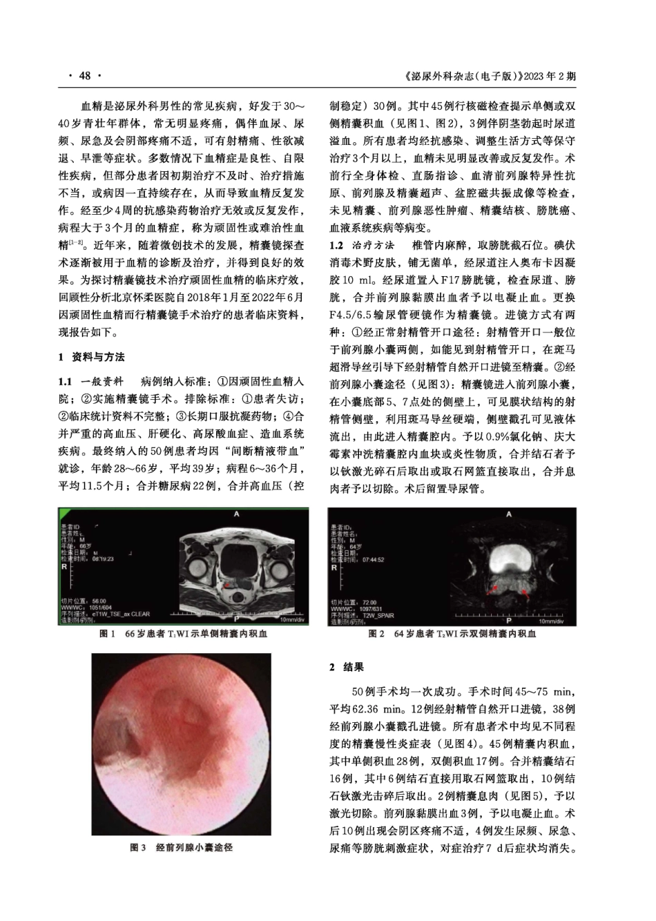 经尿道精囊镜治疗顽固性血精的临床应用效果.pdf_第2页