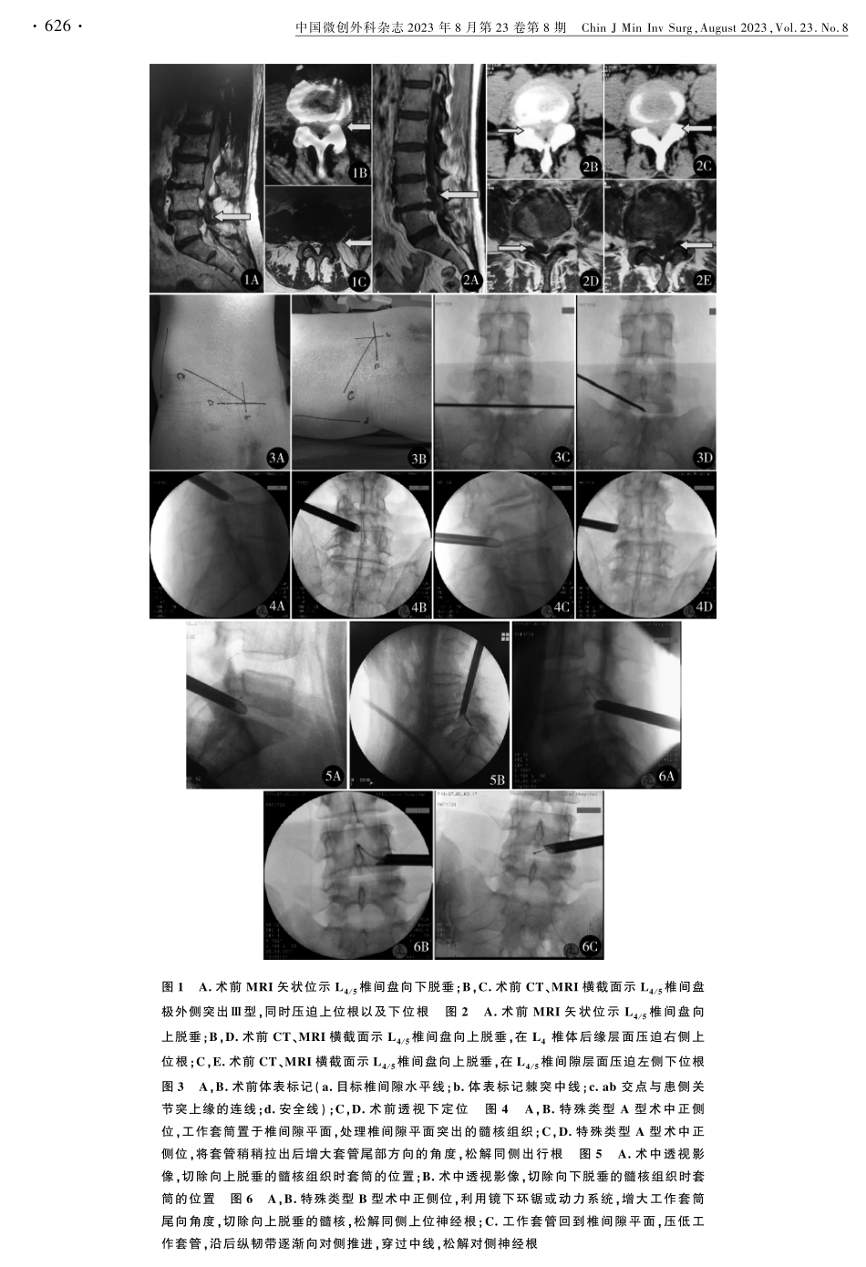 经皮椎间孔镜椎间盘切除术治疗2种特殊类型脱垂型腰椎间盘突出症.pdf_第3页